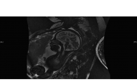 ACC MRI sagittal view